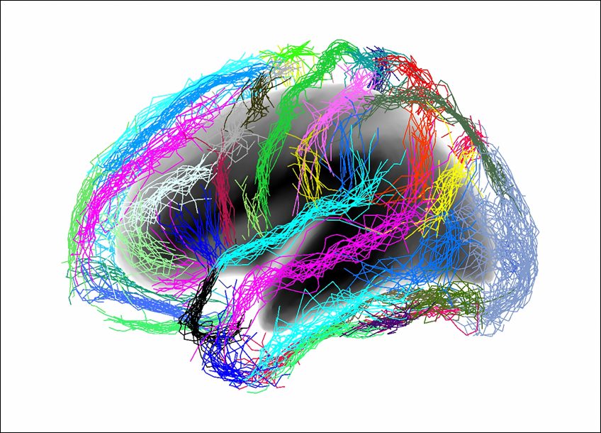 Des biomarqueurs génétiques identifiés dans la schizophrénie Des biomarqueurs génétiques identifiés dans la schizophrénie